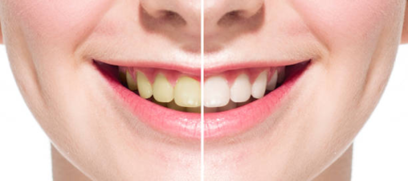 Teeth whitening in Fort Mill, SC